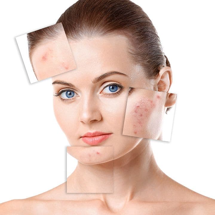 Acne Treatment in Kharadi Pune — Healthfusion Multispeciality Clinic