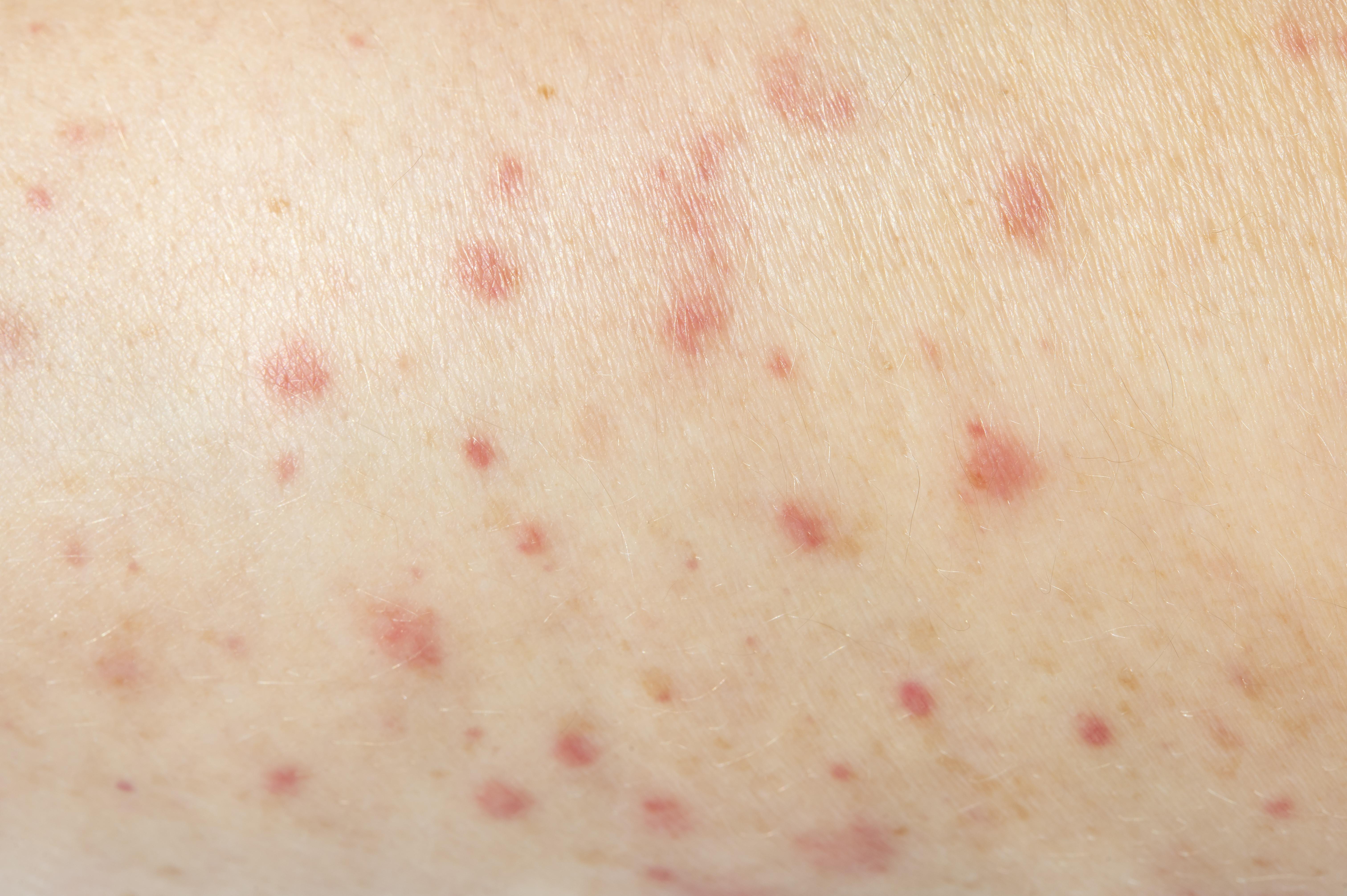 Cystic Acne